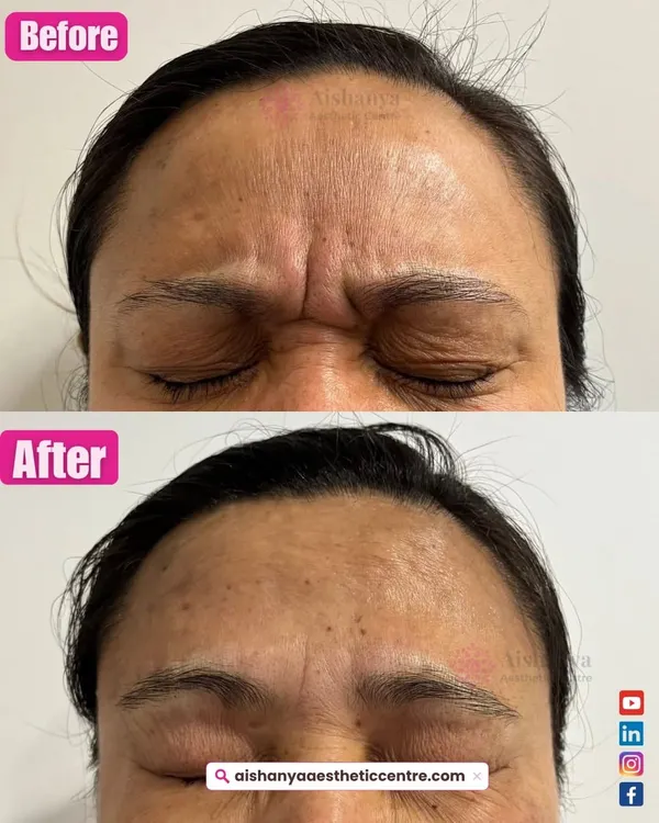Tired of looking angry or worried because of deep frown lines? I use US-FDA approved Botulinum Toxin injections to relax these specific muscles, smoothing the skin for a refreshed and approachable look. This before and after shows how a quick, 15-minute session can soften your expression naturally.