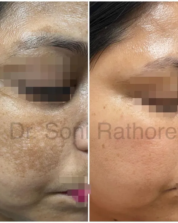 This before and after image showcases a significant reduction in melasma. We achieved this result through a multi-faceted approach including prescription creams, a series of chemical peels for pigmentation, and targeted laser treatments.