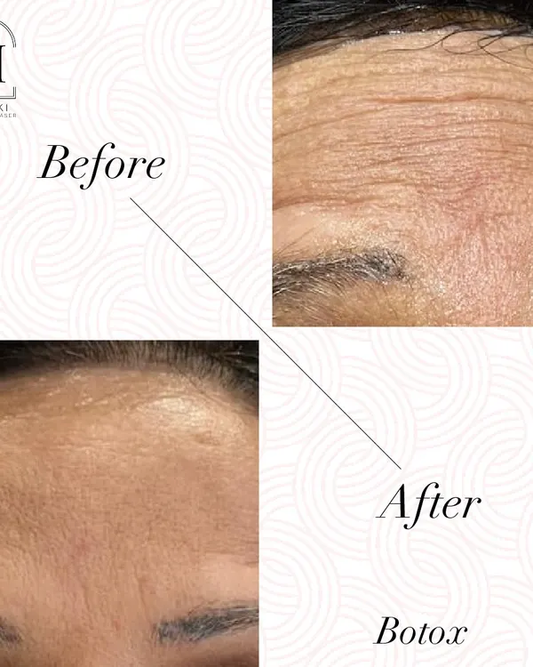 This before and after photo clearly shows the power of Botox in smoothing away deep forehead wrinkles. The result is a much smoother, more youthful appearance while maintaining a natural look.