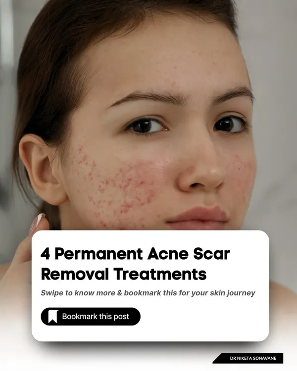 A starting point for anyone looking to understand their options for permanent acne scar removal. I offer a range of treatments because every scar type requires a different approach.