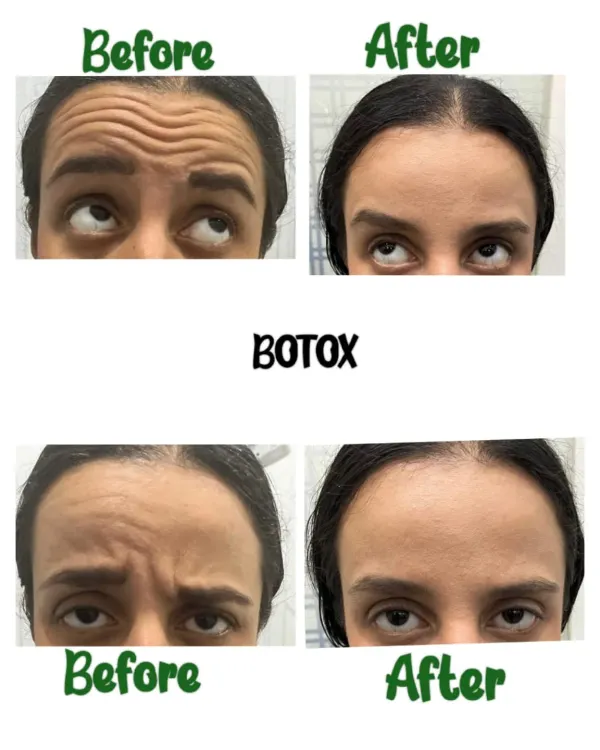 A side-by-side comparison showing the significant reduction of deep-set forehead lines and frown lines after a Botox treatment. The 'after' image displays a smooth, relaxed forehead, demonstrating a refreshed and more youthful appearance while maintaining natural expression.