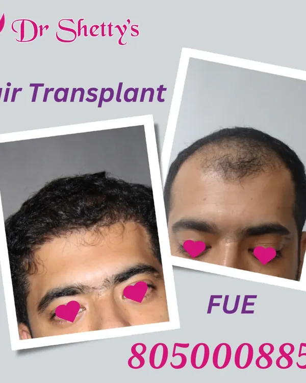 This is the result you can expect from my FUE hair transplant procedure. We focus on creating a dense, natural looking hairline that permanently restores hair to areas of thinning or baldness. Notice the significant improvement in coverage and how the transplanted hair blends seamlessly.