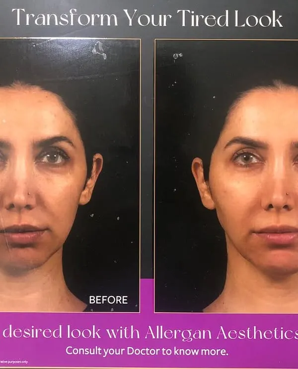 A tired look is often caused by volume loss in key areas of the face. With strategically placed facial fillers, I can restore that volume and help you achieve a naturally refreshed and vibrant appearance.