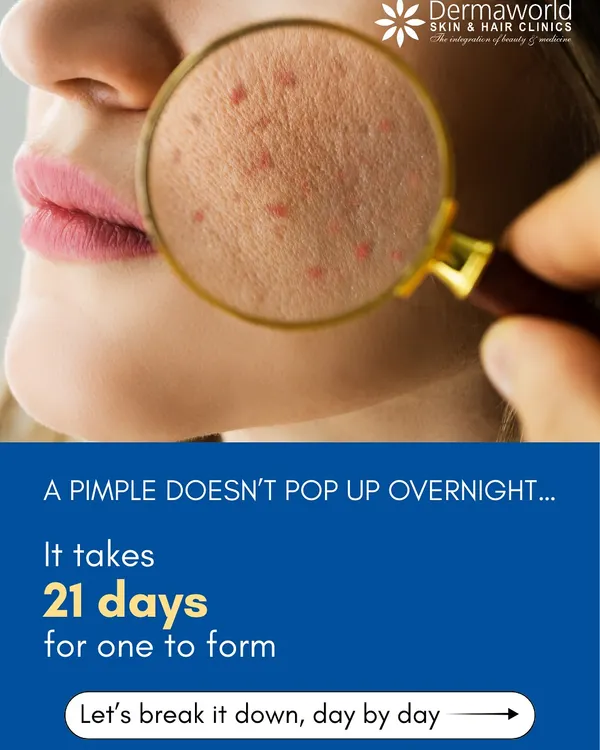 A pimple doesn't just show up overnight. This graphic shows the start of a 21-day process that happens beneath the skin. Understanding this timeline is the first step toward effective and early treatment.