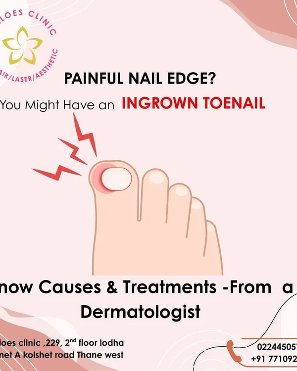 A painful edge on your toenail is a classic sign of an ingrown nail. This graphic explains the issue, which I can diagnose and treat in my clinic to prevent infection and provide immediate relief from discomfort.