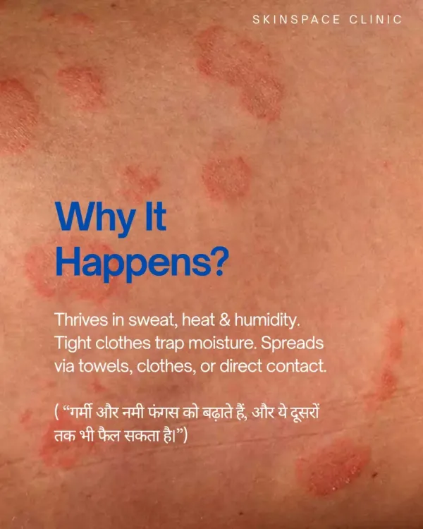 Fungal infections thrive in sweat, heat, and humidity, which is why they are so common. They can spread through shared towels or direct contact, so proper hygiene and treatment are key.
