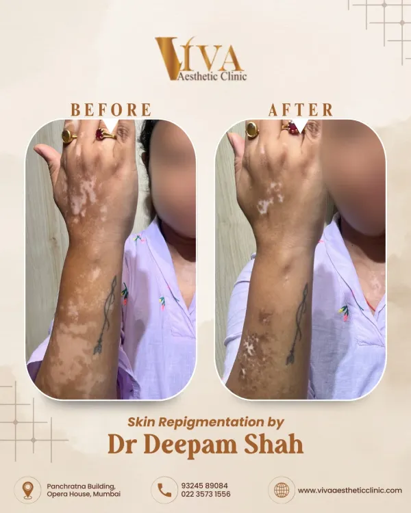 Many people believe vitiligo cannot be treated, but this before and after photo shows what is possible. For this patient, we focused on repigmenting the white patches on her arm and hand. Through a customized medical approach, we successfully restored a significant amount of her natural skin color.
