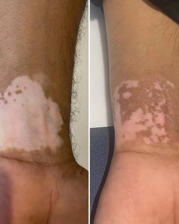 This before and after shows the repigmentation progress on a patient's wrist just six weeks after a Melanocyte Transplantation procedure. This surgical technique is an excellent option for stable Vitiligo, where we transplant healthy pigment-producing cells to the affected areas to restore skin color.