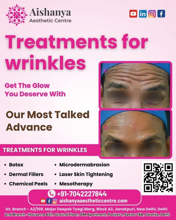 This before-and-after shows a dramatic reduction in forehead wrinkles. I use treatments like Botox to relax the underlying muscles, smoothing out deep-set lines and giving the skin a much younger, fresher appearance.