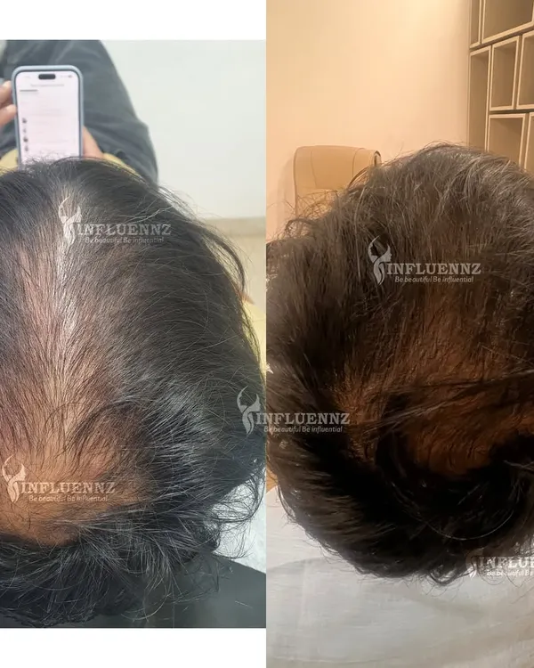This is the kind of visible result we can achieve. This client's before and after photos show a significant increase in hair density and scalp coverage after completing their personalized hair restoration plan. We focused on reactivating dormant follicles for natural, thicker regrowth.