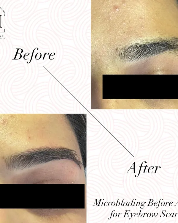 If you have scanty eyebrows or a scar, microblading is the answer. This before and after shows how I can create full, natural-looking brows that frame the face beautifully.