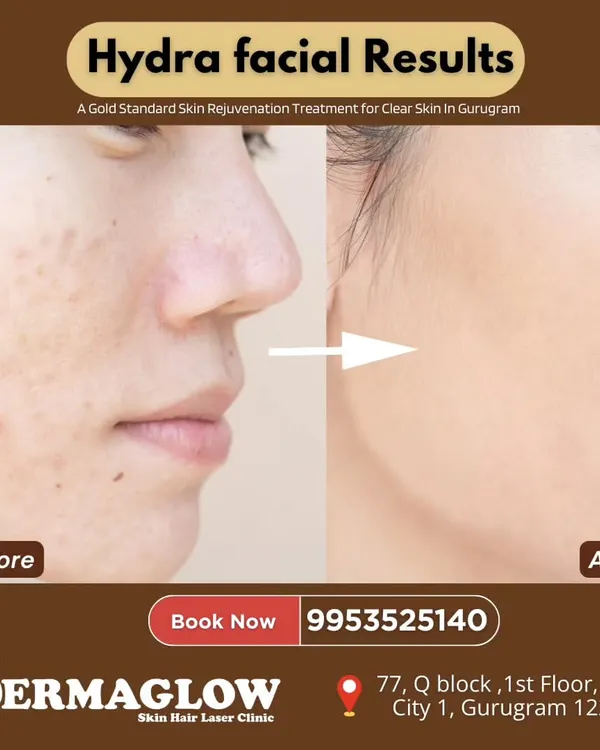 A clear before and after comparison showcasing the results of a HydraFacial. The 'after' photo displays a significant improvement in skin clarity and texture, with reduced blemishes and a brighter, more even skin tone.