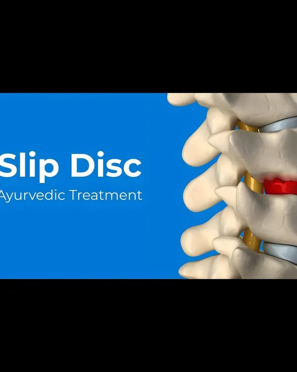 This is a duplicate of ID 18, illustrating the area affected by a slip disc. My Ayurvedic treatment offers a drug-free and non-surgical path to recovery. Therapies like Kati Basti and herbs like Dashamool ease inflammation and nourish the spinal structures to support natural healing.