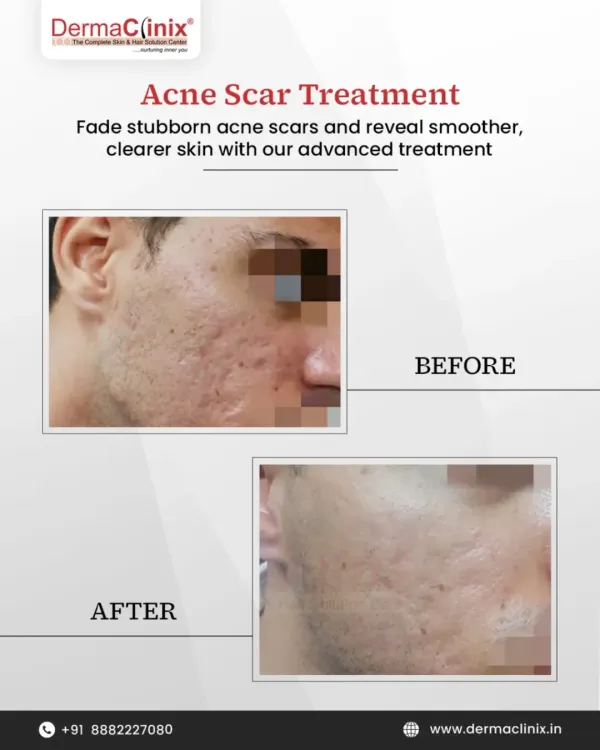 A clear before and after comparison of our advanced acne scar treatment. This result was achieved through a customized plan designed to fade stubborn marks and reveal smoother, healthier skin.