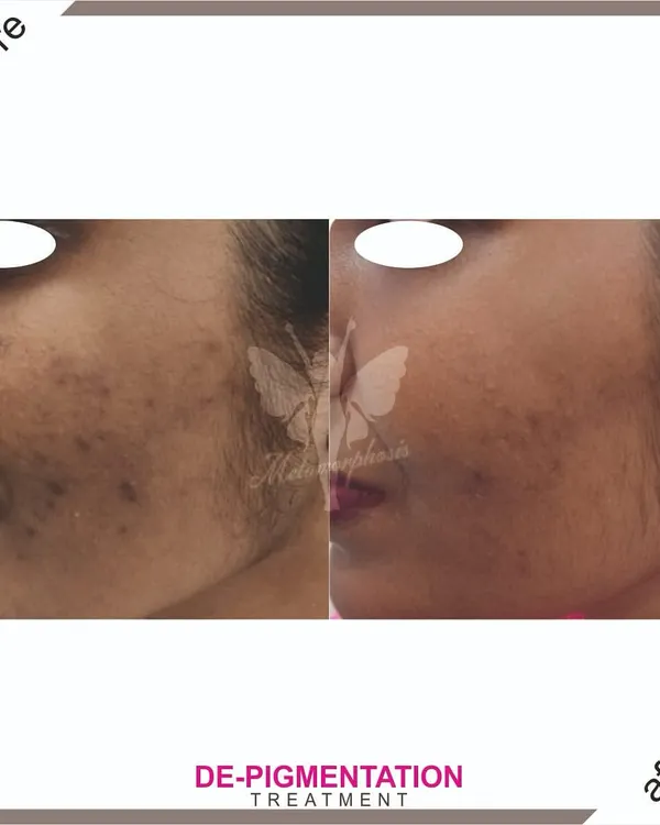 A fantastic result from our de-pigmentation treatment. This client saw a dramatic reduction in sun spots and uneven tone, achieving a much brighter and clearer complexion.