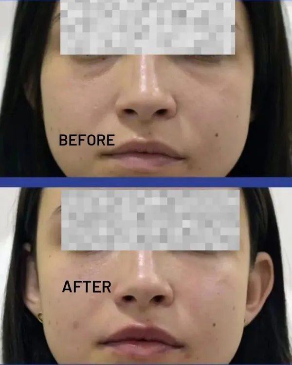 A clear before-and-after showcasing the results of filler treatment for under-eye hollows and smile lines. The 'after' image reveals a smoother transition under the eyes and softened nasolabial folds for a refreshed appearance.