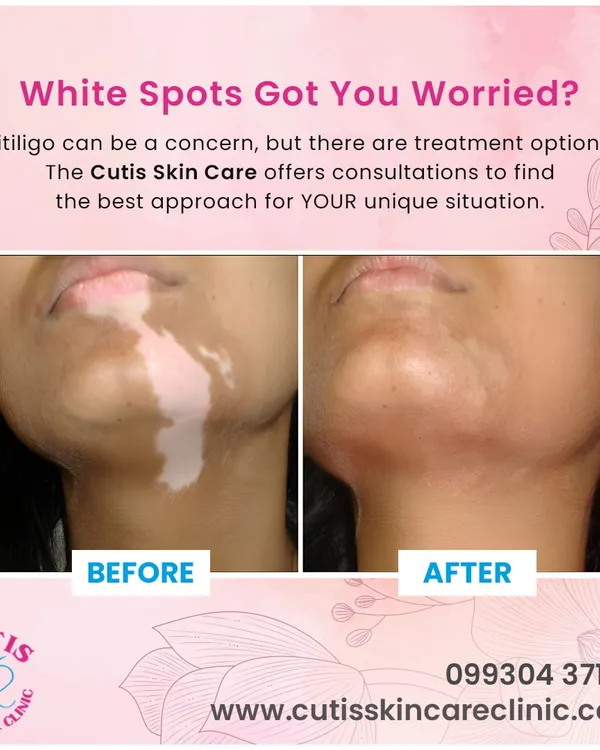 This powerful before and after image shows the significant improvement possible with our vitiligo treatments. We offer personalized consultations to find the best approach for your unique situation, helping to restore pigmentation and confidence.