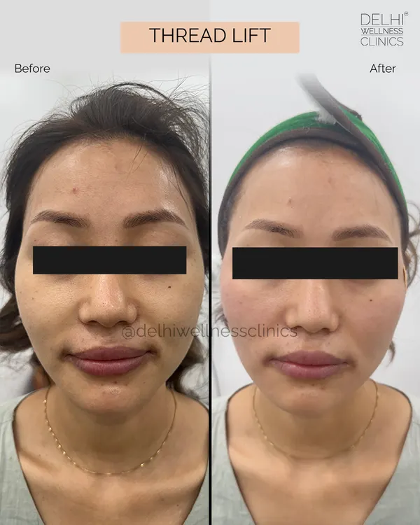 This is the power of a non-surgical thread lift. Notice the immediate lift in the jowls and a more defined, V-shaped jawline. We use dissolvable threads to stimulate your own collagen, ensuring the results are not just instant but also natural and long-lasting.