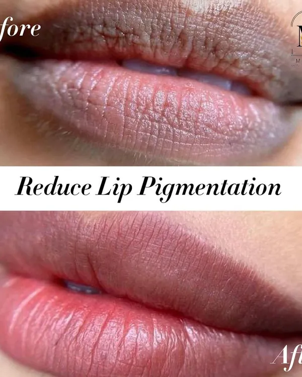 Lip pigmentation is a common concern, but it can be effectively treated. This before and after shows a significant reduction in darkness and an improvement in overall lip health and color.