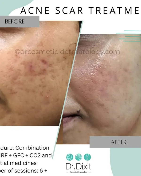 This is the result of a personalized acne scar treatment plan combining Microneedling Radiofrequency (MNRF), GFC, and CO2 laser over several sessions. My goal is to not just treat the surface but to rebuild the skin's foundation for a smoother, clearer complexion.