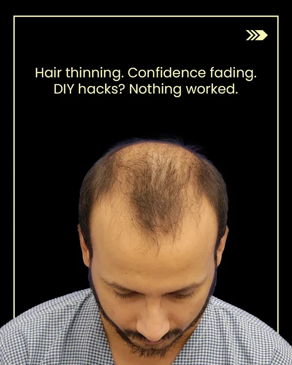 This is Dhruv Sharma before he began his journey with us. Like many, he was experiencing thinning hair and fading confidence after trying various DIY solutions that did not work.