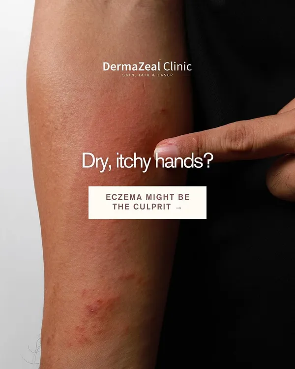 Dry, itchy hands can be a sign of eczema, a condition often triggered by daily irritants or allergens. Recognizing this is the first step toward finding a solution that works for you.