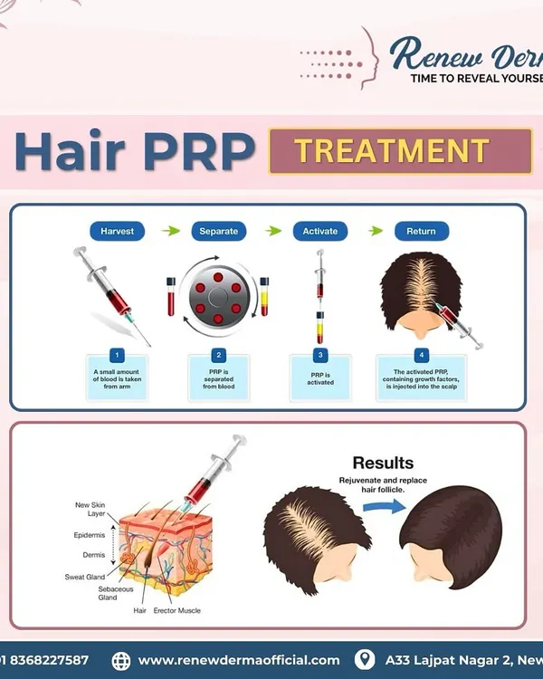 This graphic explains the four simple steps of a Hair PRP treatment: we harvest a small amount of your blood, separate the plasma, activate the growth factors, and return the activated PRP to your scalp. This process rejuvenates hair follicles for stronger growth.