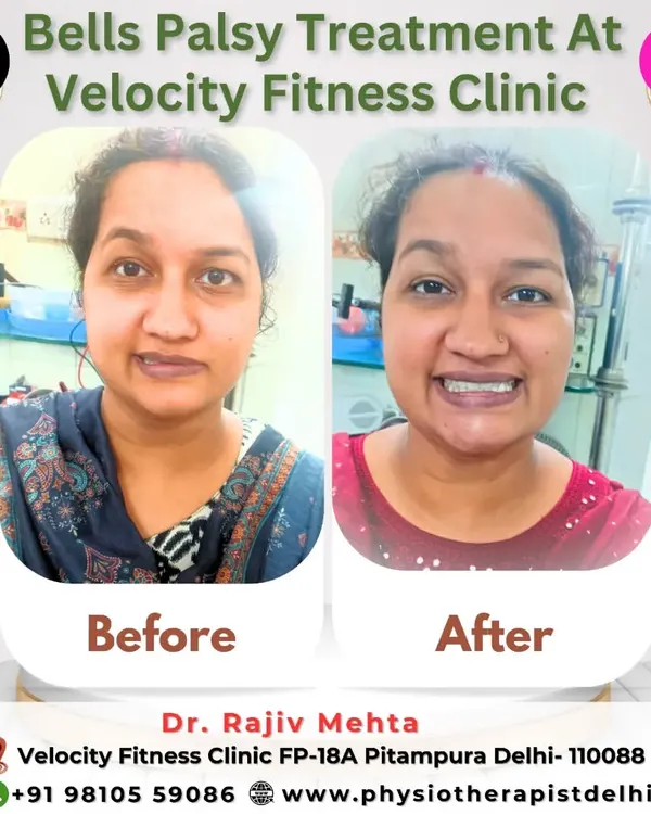 A powerful before and after of a patient's recovery from Bell's Palsy. We used a combination of facial exercises and stimulation to help her regain muscle control and her confident smile.
