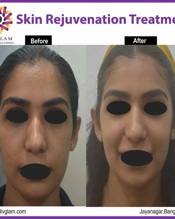 This client underwent a GFC (Growth Factor Concentrate) treatment to rejuvenate her skin. The 'after' photo shows improved skin texture, reduced blemishes, and an overall healthier, more vibrant complexion.