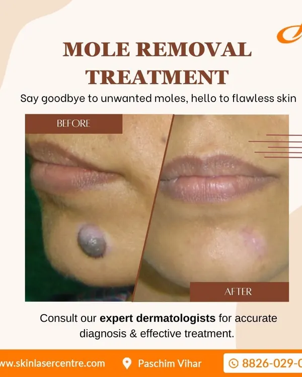 This before and after image shows the result of a CO2 laser mole removal I performed. The procedure is precise and quick, effectively removing the mole while aiming for minimal scarring and clear skin.