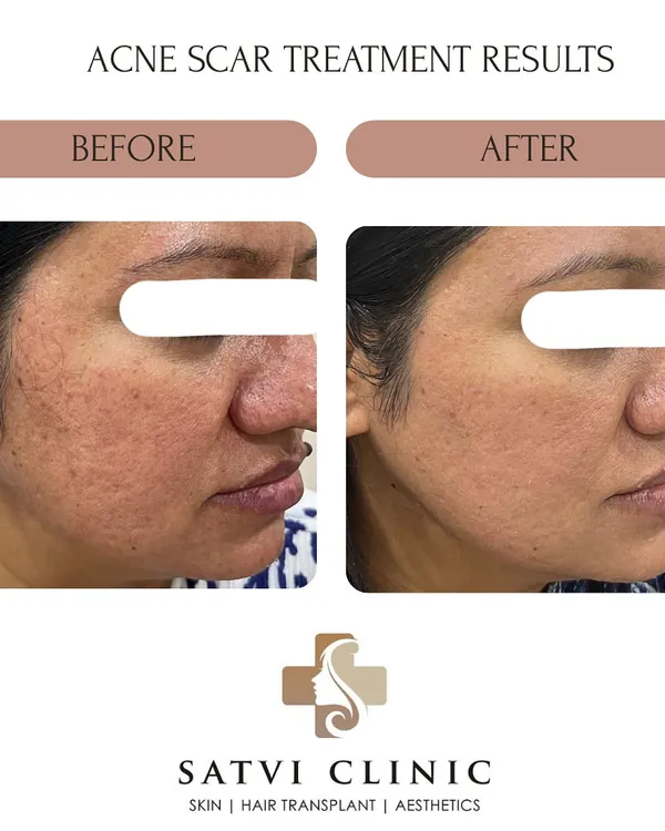 This patient saw a significant reduction in acne scars and improved skin texture after a personalized treatment plan involving Microneedling and CO₂ Laser sessions. Achieving clear skin is a journey, and I guide my patients through every step.