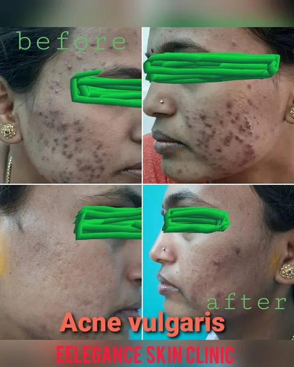 This before and after image shows the significant improvement in post adolescent acne after a personalized treatment plan at my clinic. We focus on clearing active acne and reducing inflammation for healthier, clearer skin.