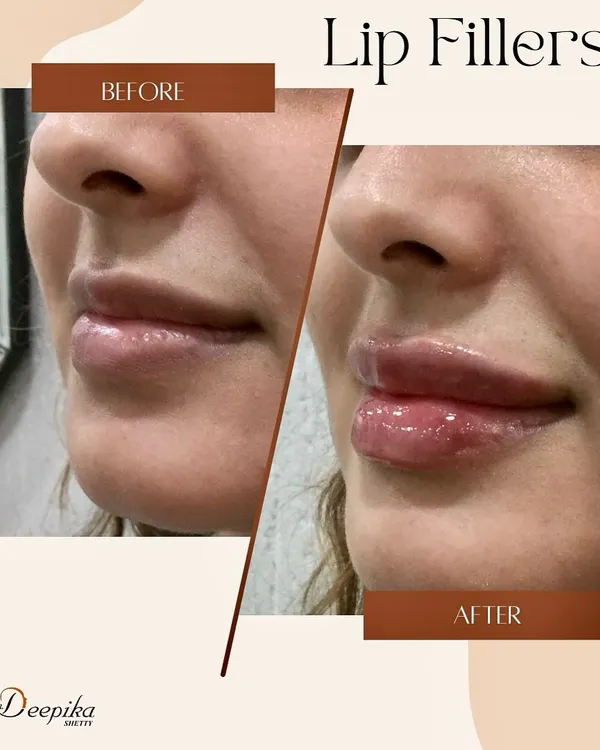 Here you can see a beautiful, natural enhancement using lip fillers. My focus is on creating balanced volume and a defined shape that complements your unique features, resulting in fuller lips that don't look overdone. This before and after showcases how we can achieve a plumper, more youthful look with minimal downtime.