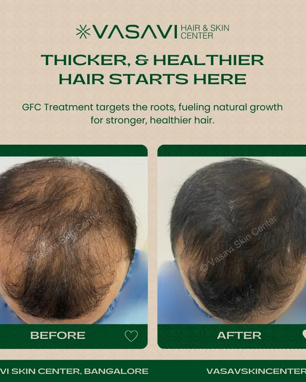 This image shows the significant improvement in hair density and scalp coverage for one of my patients. This result was achieved through a personalized GFC treatment plan designed to address androgenetic alopecia, or pattern baldness, by revitalizing hair follicles.