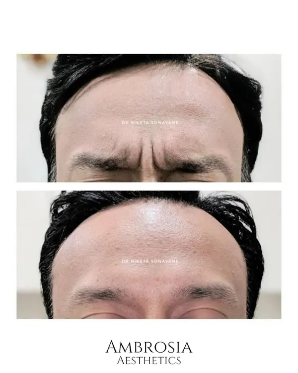 This before-and-after shows how precisely placed Botox can smooth deep-set frown lines. The goal is to relax the overactive muscles, not freeze expressions, resulting in a naturally refreshed and less worried appearance.