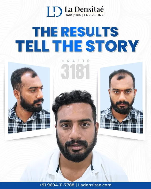 For Mr. Devi Prasad, the goal was to bring back the version of himself he missed. By implanting 3,181 grafts, I was able to fill in the thinning areas and rebuild a strong, natural-looking hairline that completely transformed his appearance.