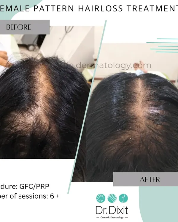This is a powerful example of how a personalized treatment plan can make a significant difference. This patient was experiencing female pattern hair loss, and after a course of GFC and PRP sessions, we were able to achieve this significant increase in hair density and scalp coverage.