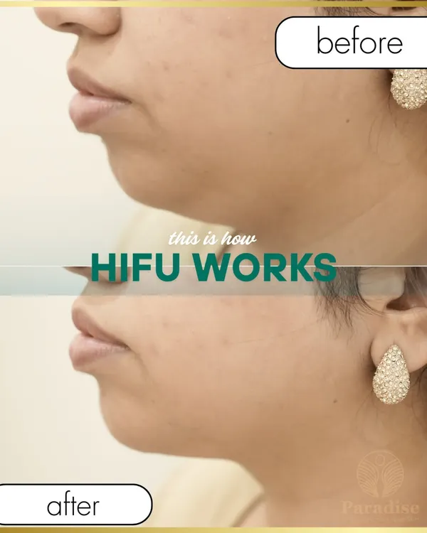 This is the power of a non-surgical facelift. This before and after shows the incredible lifting and tightening of the jawline achieved with my HIFU treatment, which uses focused ultrasound to stimulate collagen deep within the skin for a naturally sculpted look.