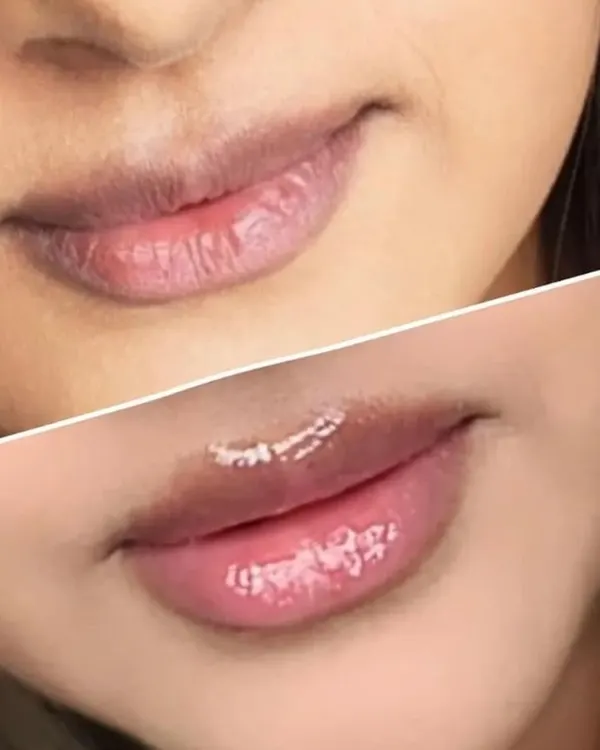This transformation focused on correcting mild pigmentation on the upper lip and adding a soft, warm color. The result is a balanced, healthy-looking pout with a subtle shine, enhancing the client's natural lip shape.