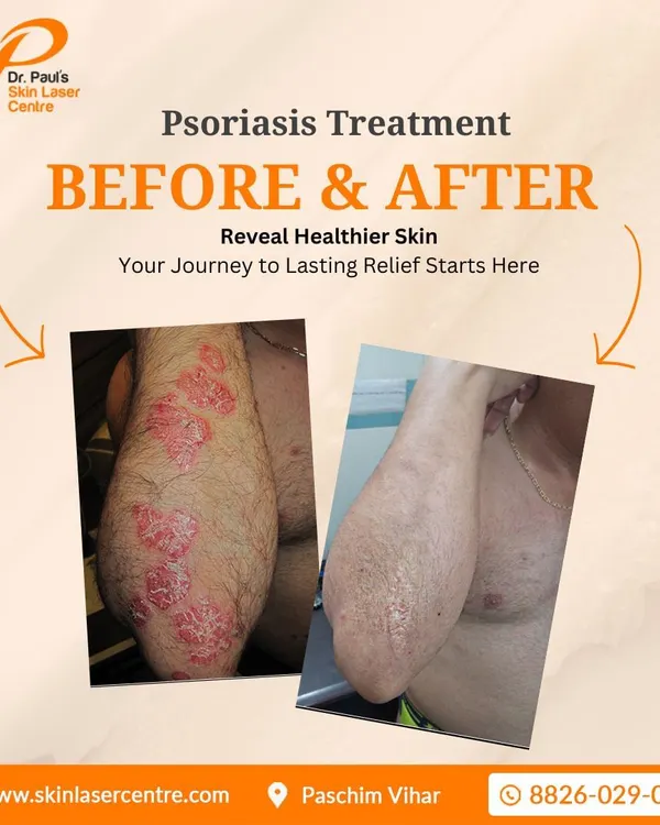 (Hero Media) This is a powerful example of how a targeted treatment plan can manage a chronic condition like psoriasis. The image on the left shows the inflamed, scaly plaques on the patient's arm before treatment, and the right shows the same arm with clear, healthy-looking skin after a course of therapy, providing significant relief from discomfort.