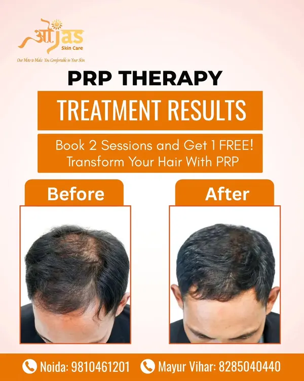 This before-and-after image shows the tangible results of my Platelet-Rich Plasma (PRP) therapy. We focus on achieving visible hair density and restoring your natural hairline for a significant confidence boost.
