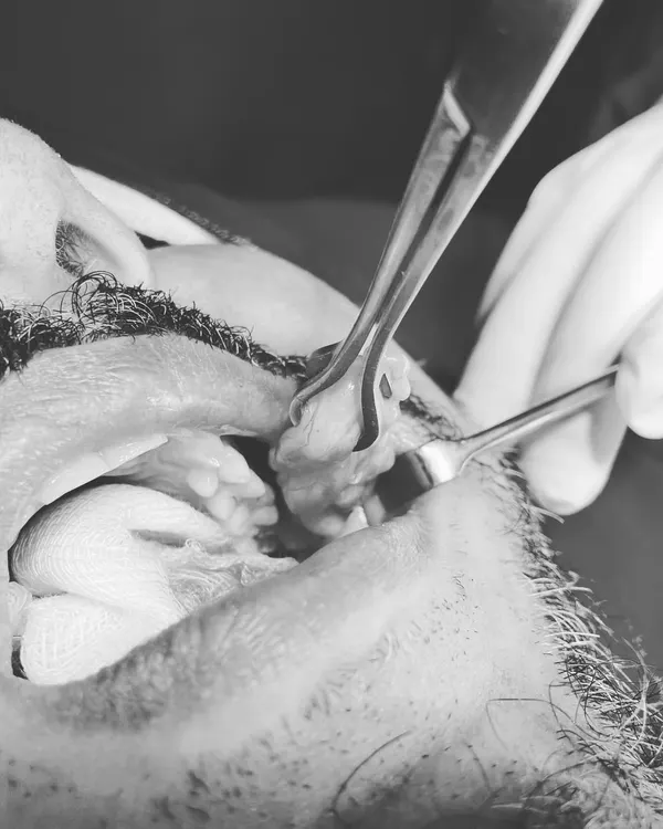 This image shows the buccal fat pad being removed during a buccal fat removal procedure. This is a simple and effective surgery performed under local anesthesia to create slimmer, more contoured cheeks.