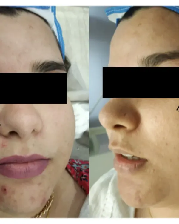 A side-by-side comparison showing a significant reduction in active acne and inflammation on the chin and cheek area after a personalized treatment course.
