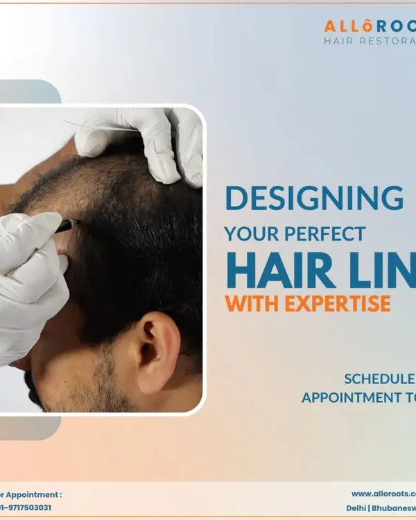 Designing the perfect hairline is a blend of art and science. I meticulously plan the hairline to suit your facial structure and age, ensuring the final result is both natural and aesthetically pleasing. Your journey to a renewed look starts with this crucial planning phase.