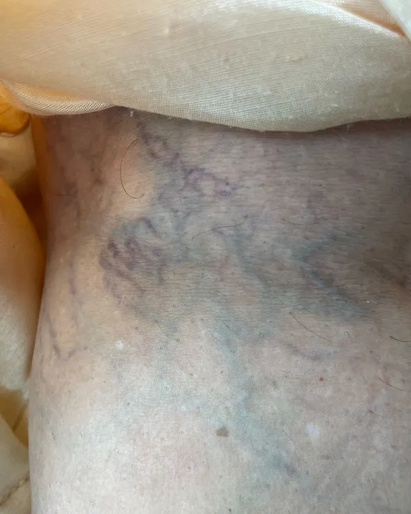 This image shows the initial state of severe varicose veins on a client's leg before beginning treatment. Such conditions can cause significant aching, heaviness, and swelling.