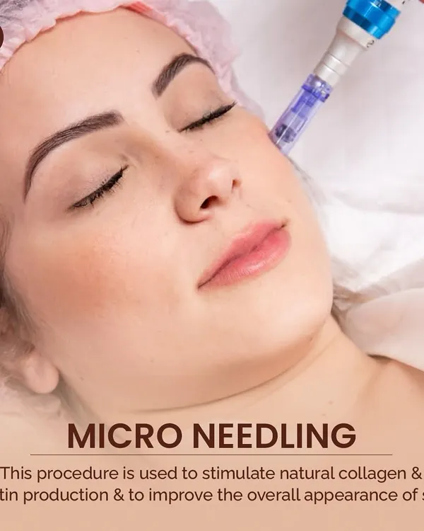 Microneedling is a procedure I use to stimulate natural collagen and elastin production. It is highly effective for improving the overall appearance of the skin, especially for acne scars and fine lines.