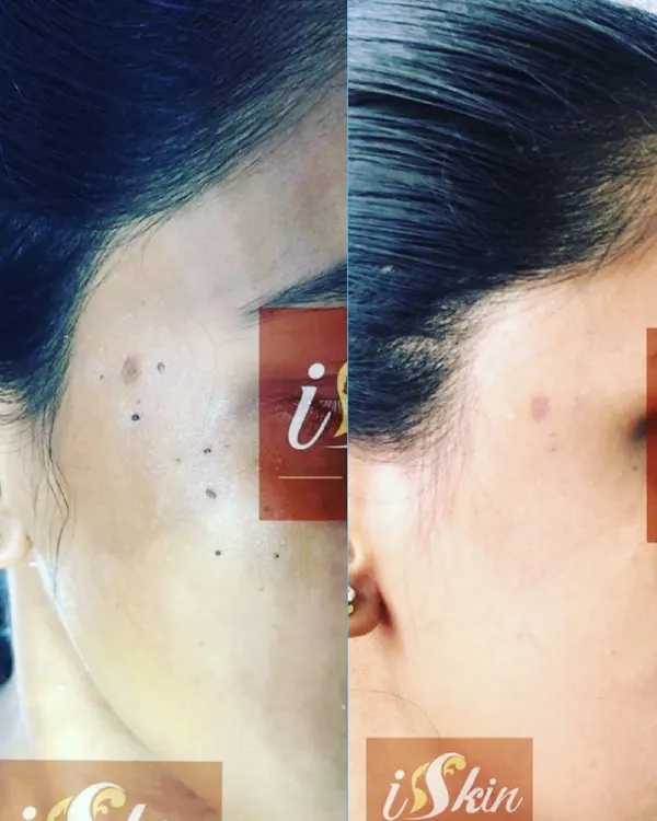 A patient's result after a non-surgical procedure to remove multiple moles from the side of her face. The treatment left the skin clear and smooth, without any scarring.