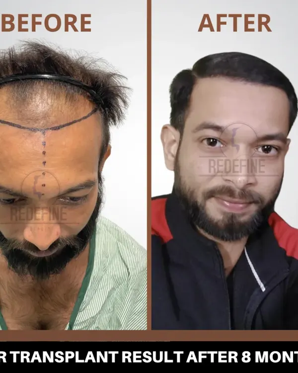 This is the result that makes it all worthwhile. After just eight months, this client regained not just his hair but a whole new level of confidence with our FUE hair transplant. We focused on creating a natural-looking hairline that perfectly frames his face, providing a permanent solution to hair loss.