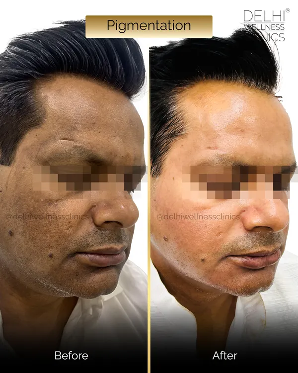 I know how frustrating stubborn pigmentation can be. This client came to me with significant dark patches and an uneven skin tone. Using a personalized treatment plan, we were able to achieve this clear, glowing result, restoring not just the skin's health but also their confidence.