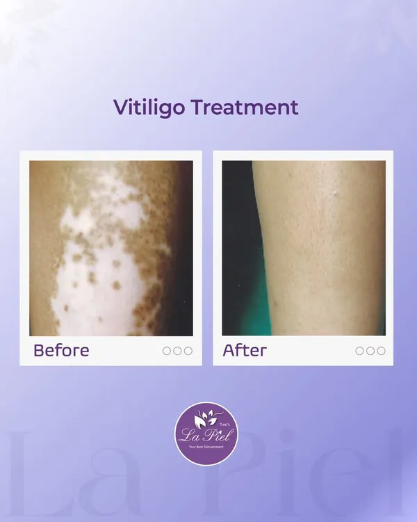 This before-and-after image is a powerful example of a successful vitiligo treatment. Our goal is to help restore pigmentation and achieve a more even skin tone, and this result showcases the visible progress that is possible with a dedicated and medically supervised plan.